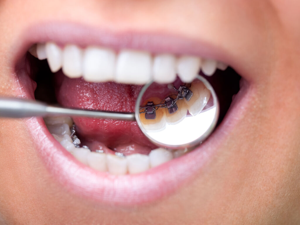 Ortodoncia Lingual: La Solución Estética y Eficaz para una Sonrisa Perfecta