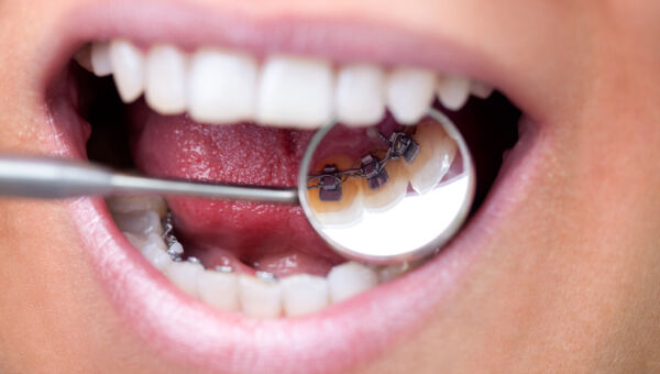 Ortodoncia Lingual en Uno Salud Dental