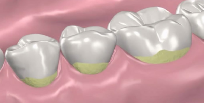 Gingivitis