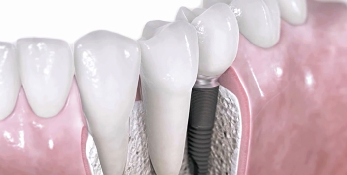Implantes dentales