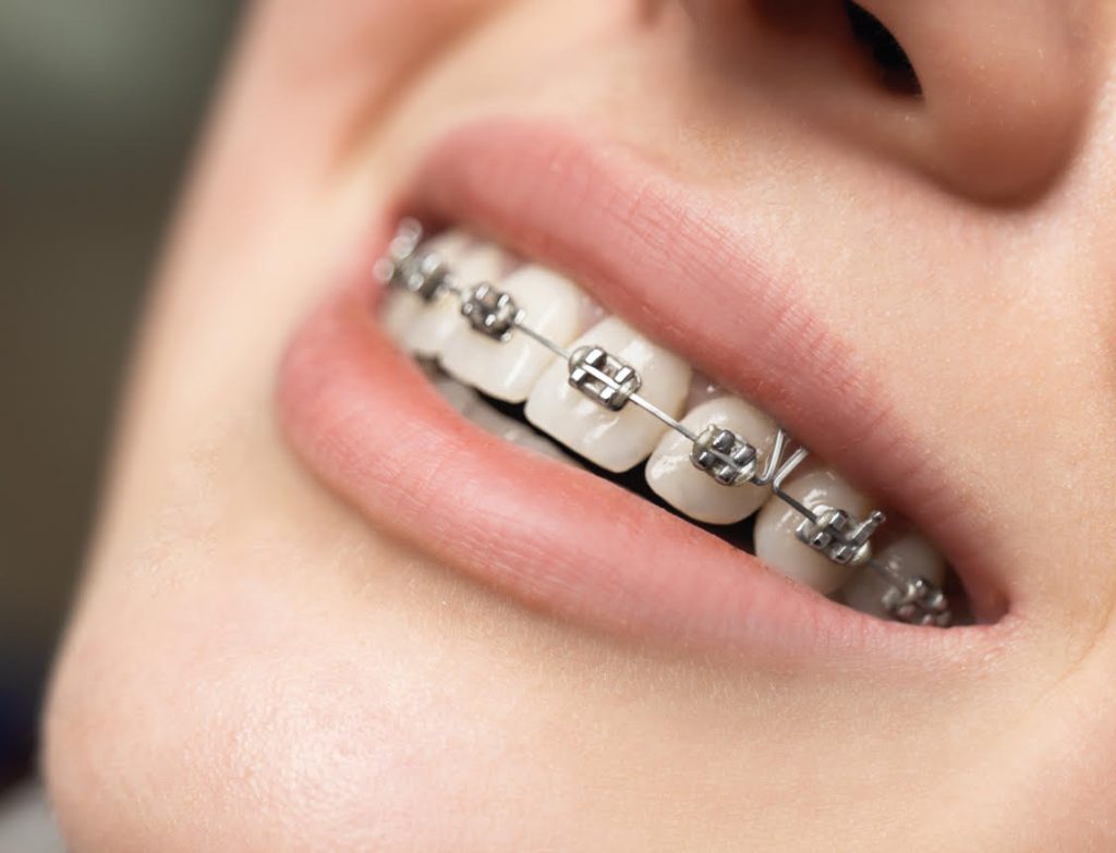 Ortodoncia metálica