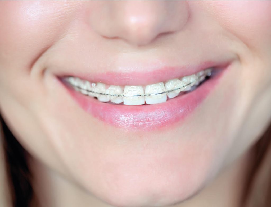 Ortodoncia estética