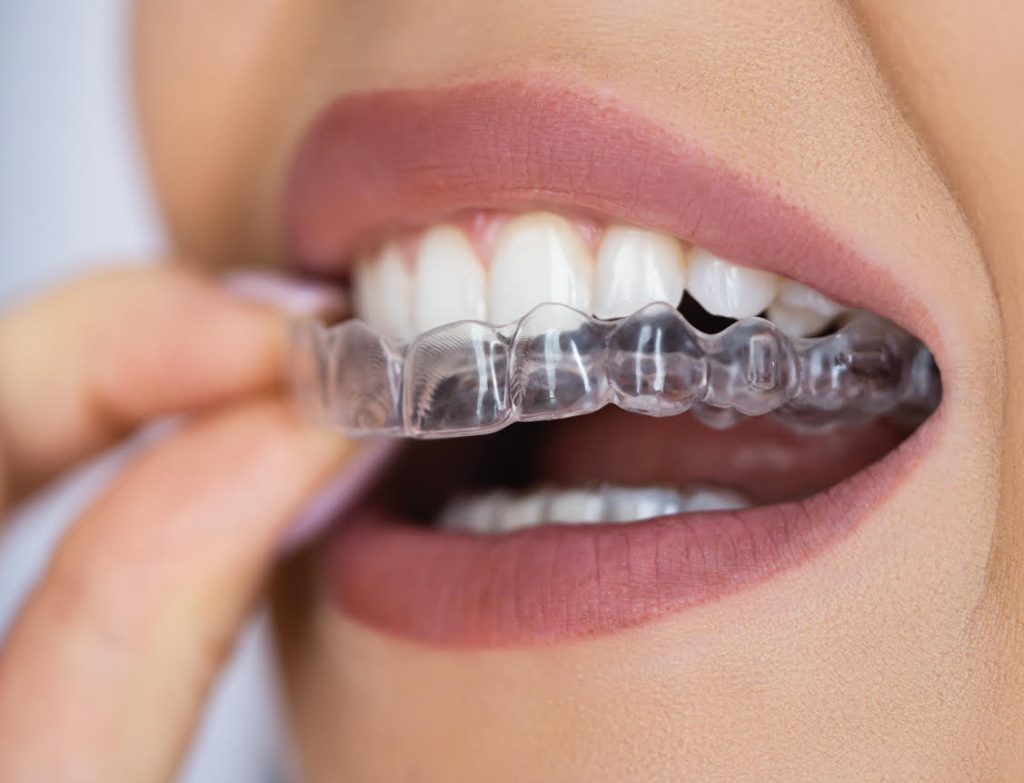 Ortodoncia invisible