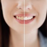 ¿Cuánto dura el blanqueamiento dental?: Todo lo que necesitas saber