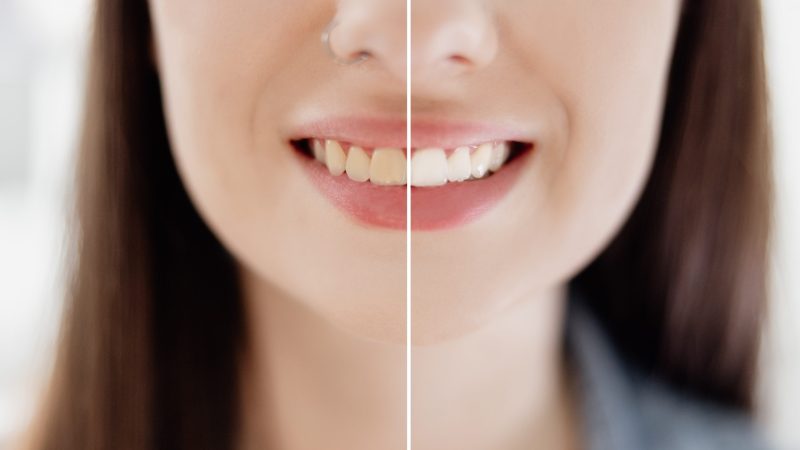 ¿Cuánto dura el blanqueamiento dental?: Todo lo que necesitas saber