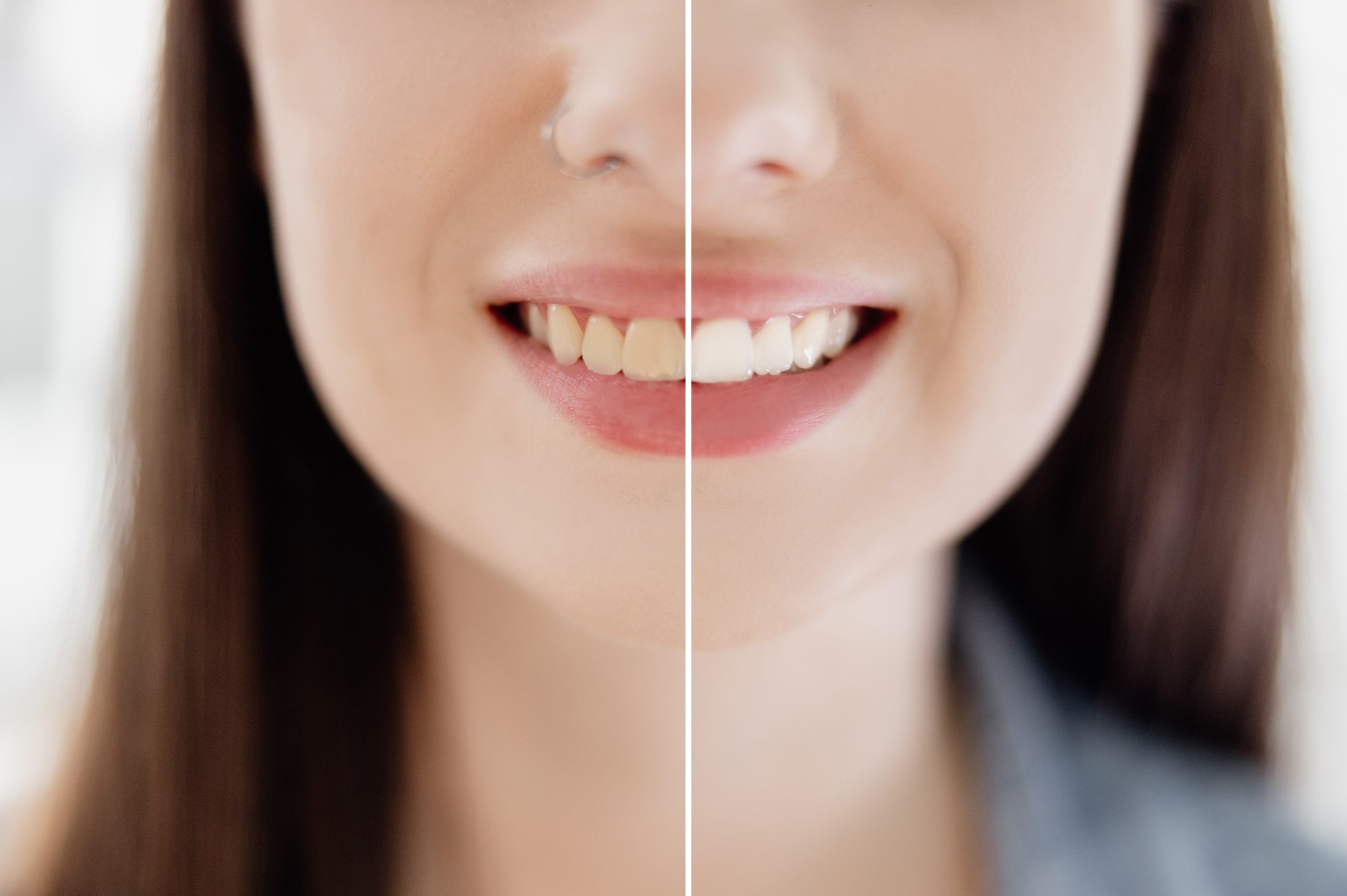 ¿Cuánto dura el blanqueamiento dental?: Todo lo que necesitas saber