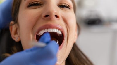 Limpieza de dientes: ¿Cuándo debes hacerla?