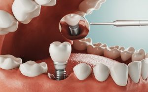 Segunda etapa implantes dentales