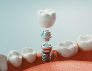 Pilar de implante dental
