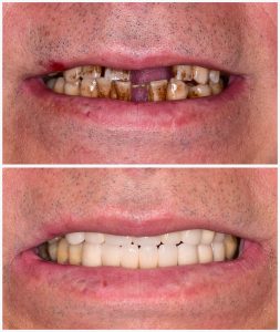 Implantes dentales antes y después