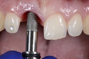 Colocación implante dental