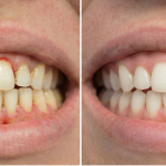 ¿Qué es pulido radicular y cuándo se realiza?