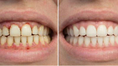 ¿Qué es pulido radicular y cuándo se realiza?