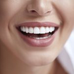 ¿Qué son las carillas dentales?: Transforma tu sonrisa