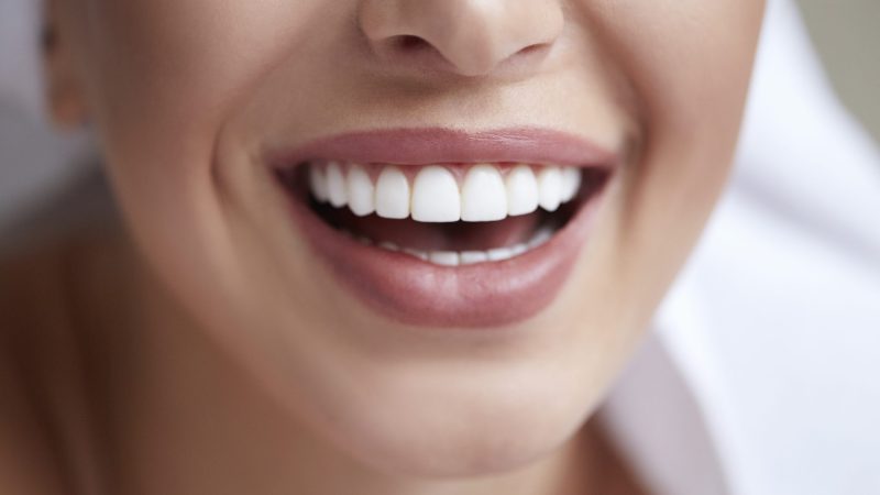 ¿Qué son las carillas dentales?: Transforma tu sonrisa