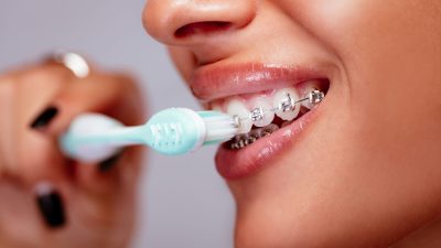 Cepillo de dientes para brackets: cómo elegir el ideal para tu sonrisa