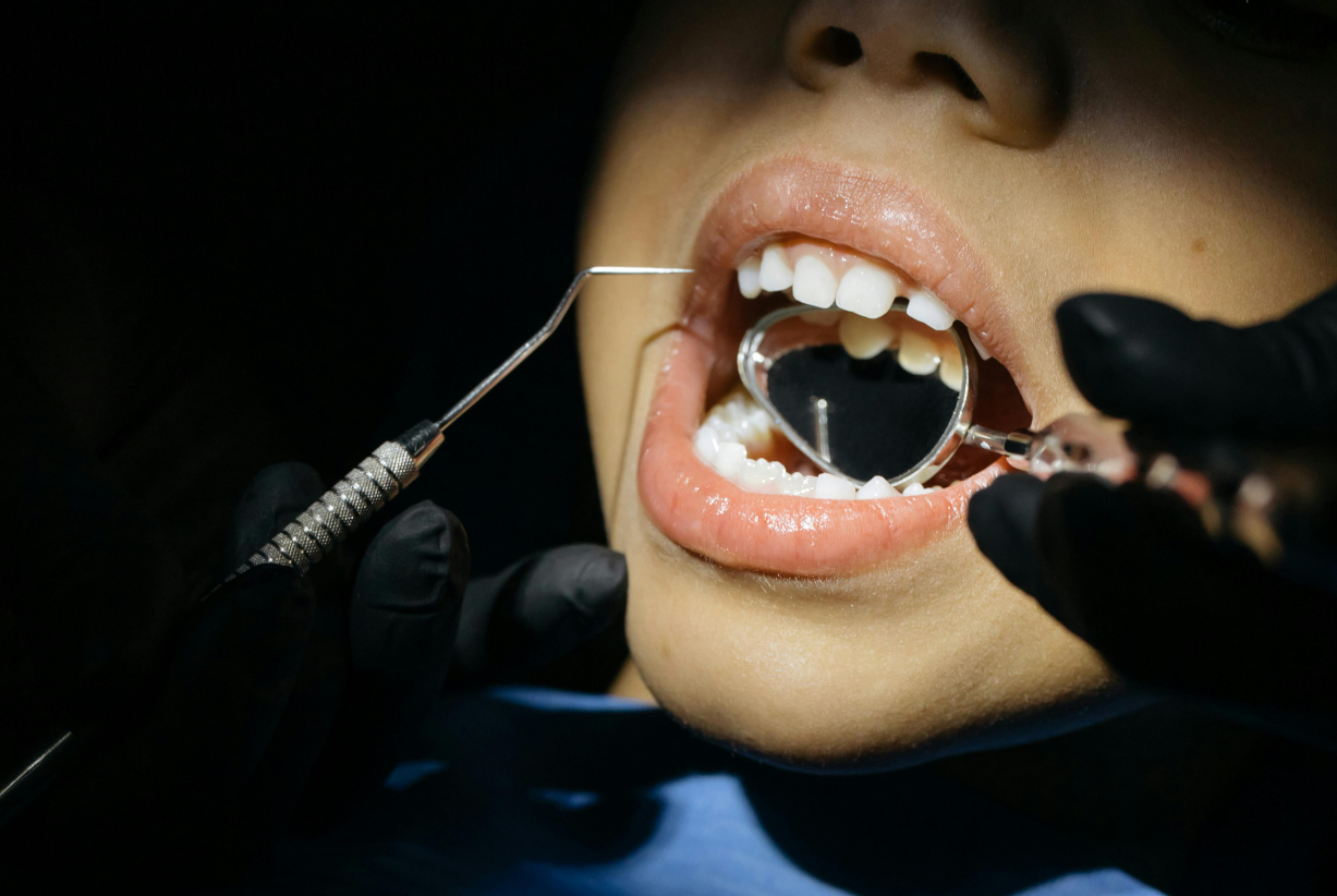 Causa de las caries en niños