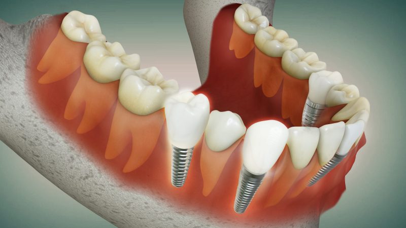 Nuevas tecnologías dentales para atrofia ósea