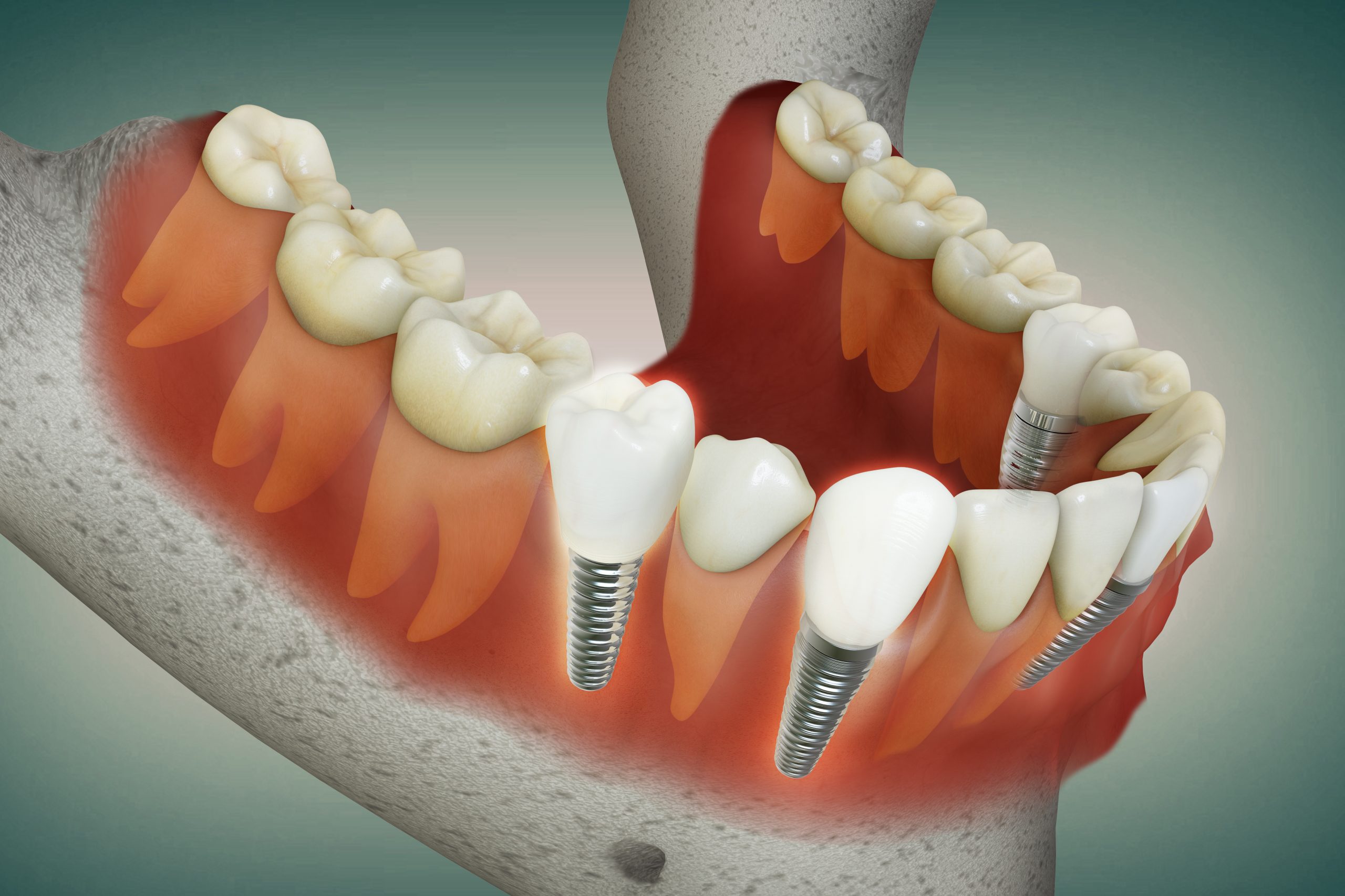 Implantes dentales múltiples 3D