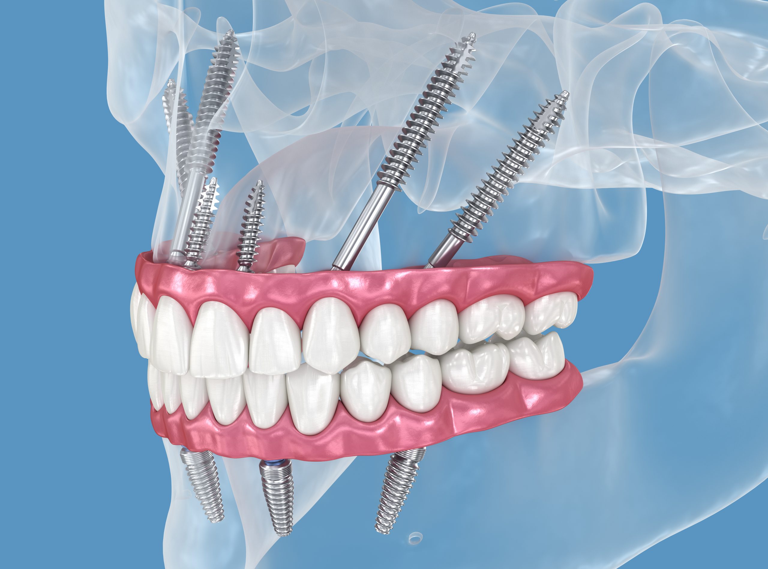 Implantes dentales cigomáticos 3D