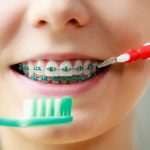 ¿Cómo cepillarse los dientes con brackets: guía paso a paso?