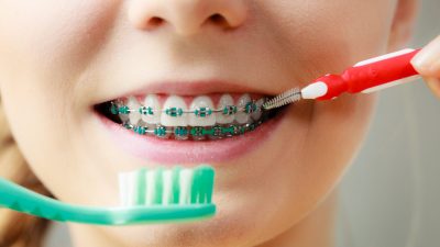 ¿Cómo cepillarse los dientes con brackets: guía paso a paso?