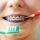 ¿Cómo cepillarse los dientes con brackets?: Guía paso a paso