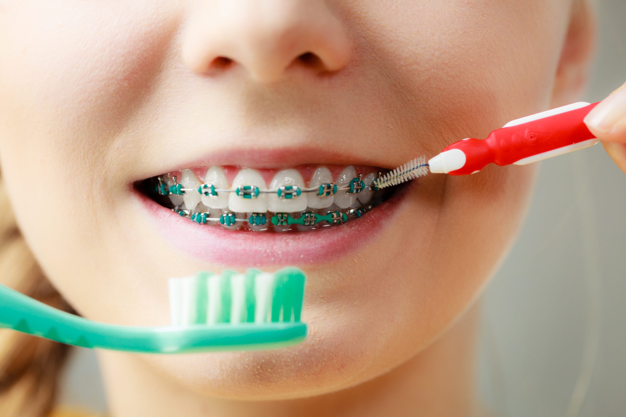 ¿Cómo cepillarse los dientes con brackets: guía paso a paso?