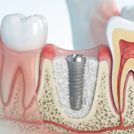 Injerto óseo dental: ¿Para qué sirve?
