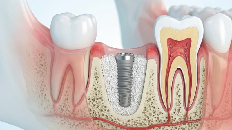 Injerto óseo dental: ¿Para qué sirve?