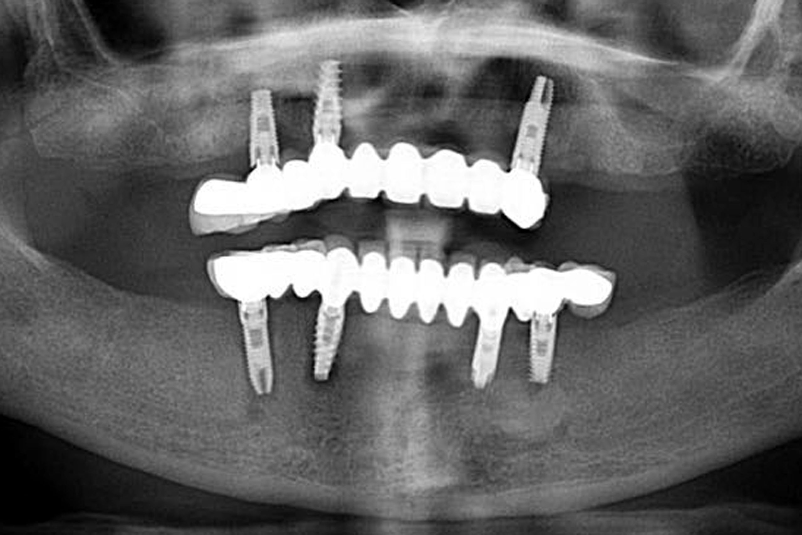 Radiografía de paciente con implantes cigomáticos