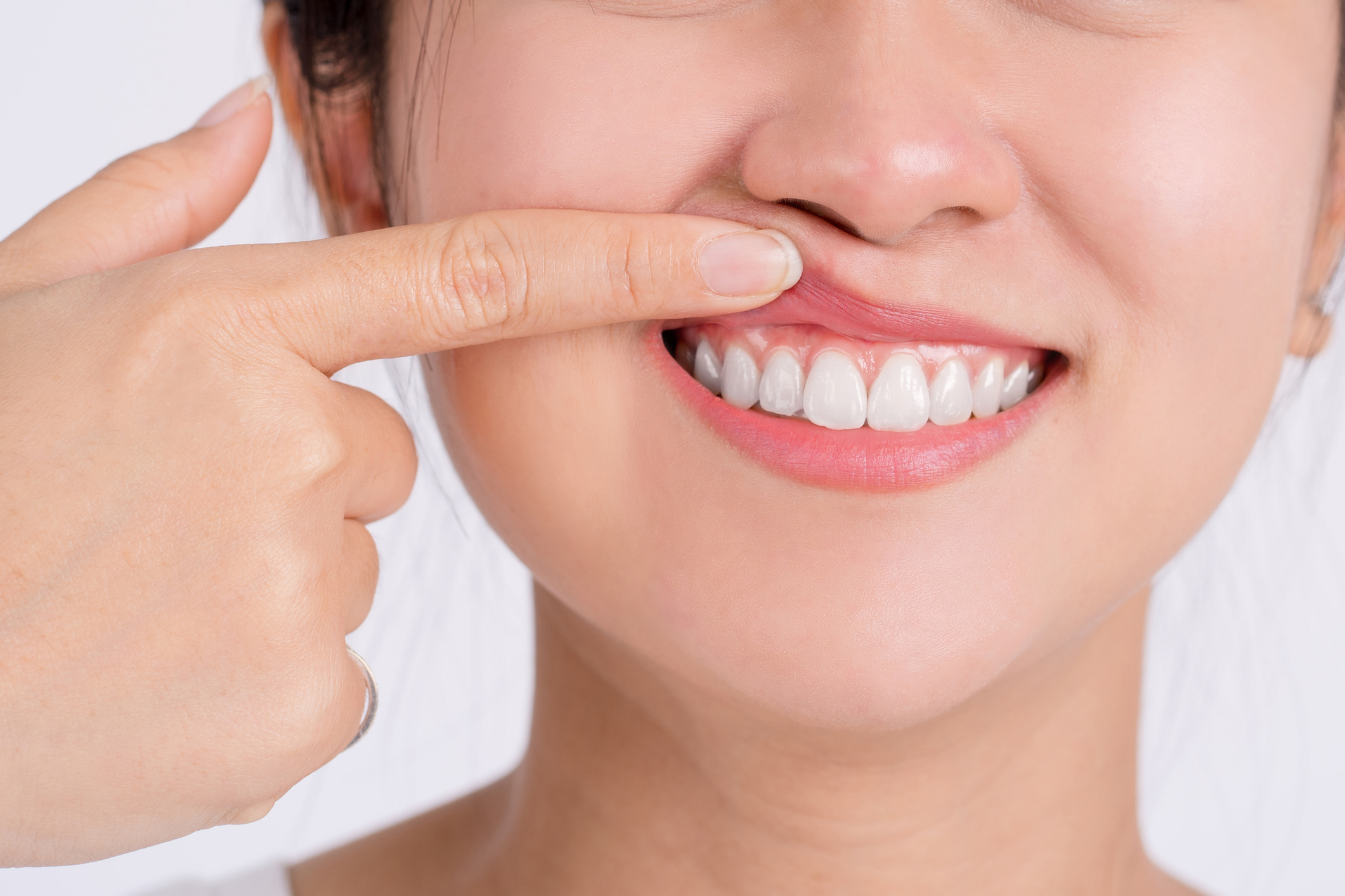 Mujer post tratamiento de periodontitis avanzada