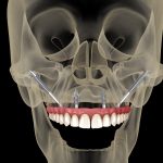 Implantes cigomáticos: qué son y cuándo se recomiendan