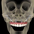 Implantes cigomáticos: qué son y cuándo se recomiendan