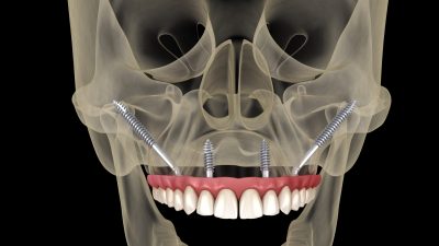 Implantes cigomáticos: qué son y cuándo se recomiendan