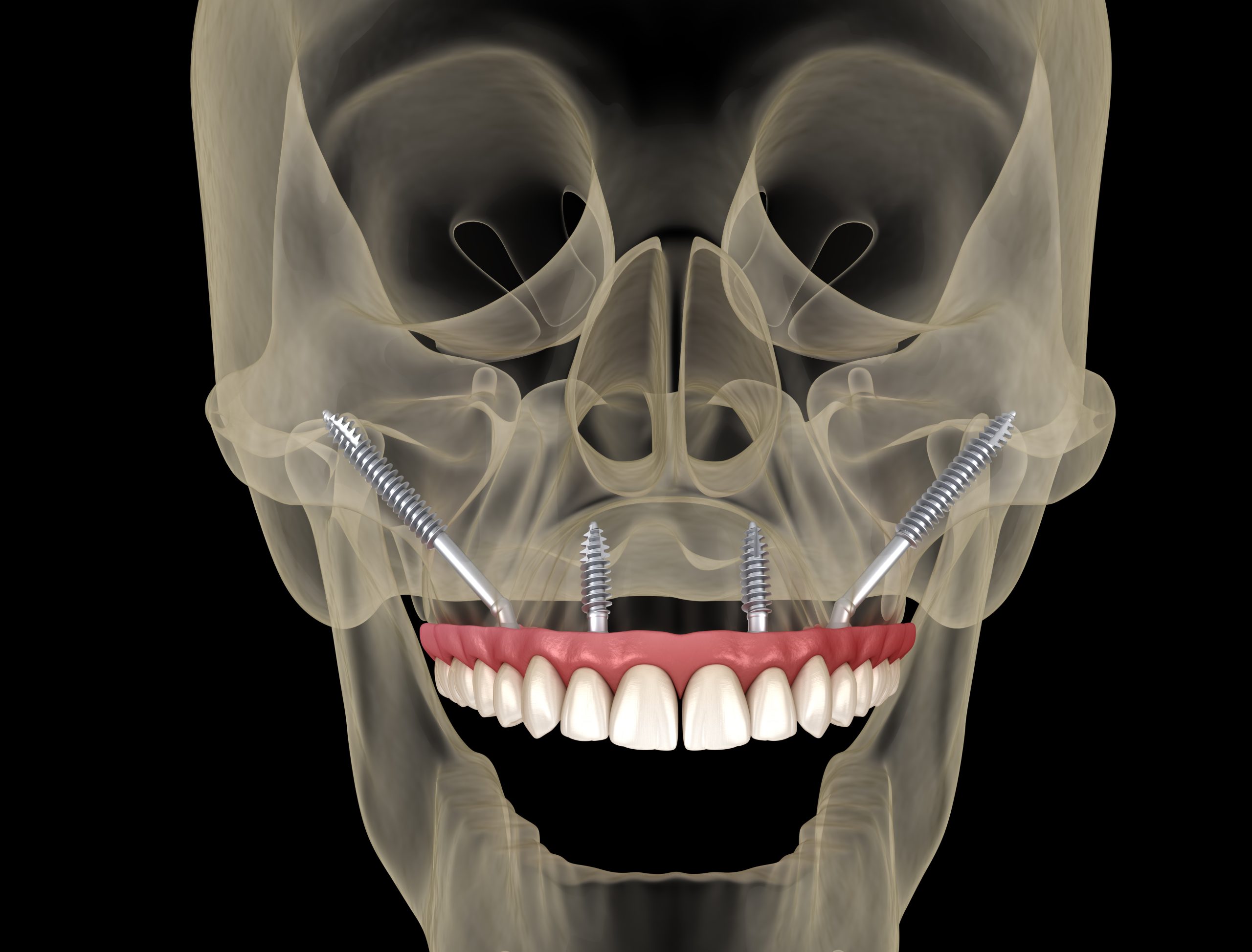 Imagen 3D de implantes cigomáticos