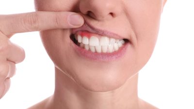 Periodontitis: riesgos y consecuencias