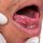 Cáncer oral: qué es síntomas y señales de alerta