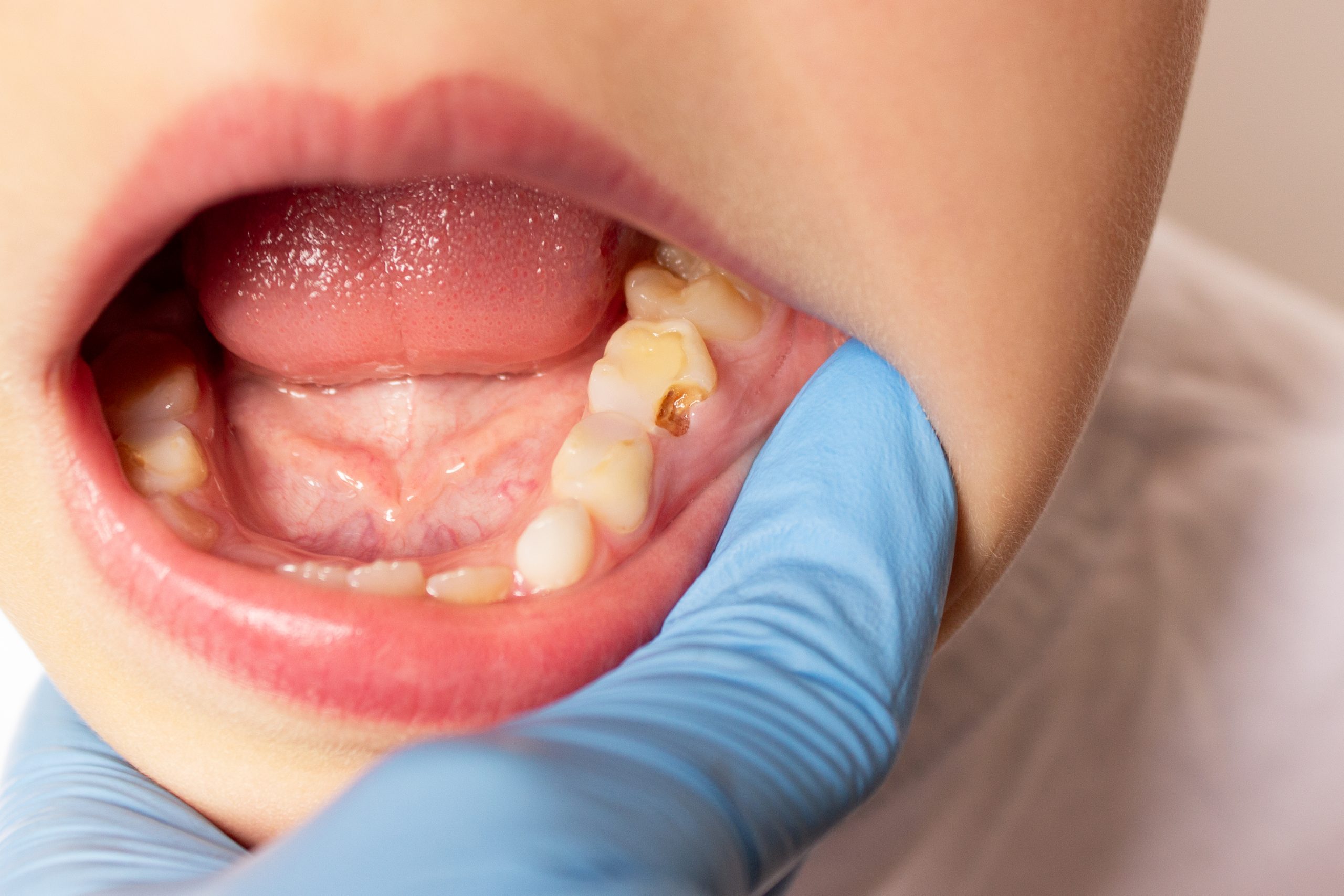 Niño en control dental para diagnóstico de caries