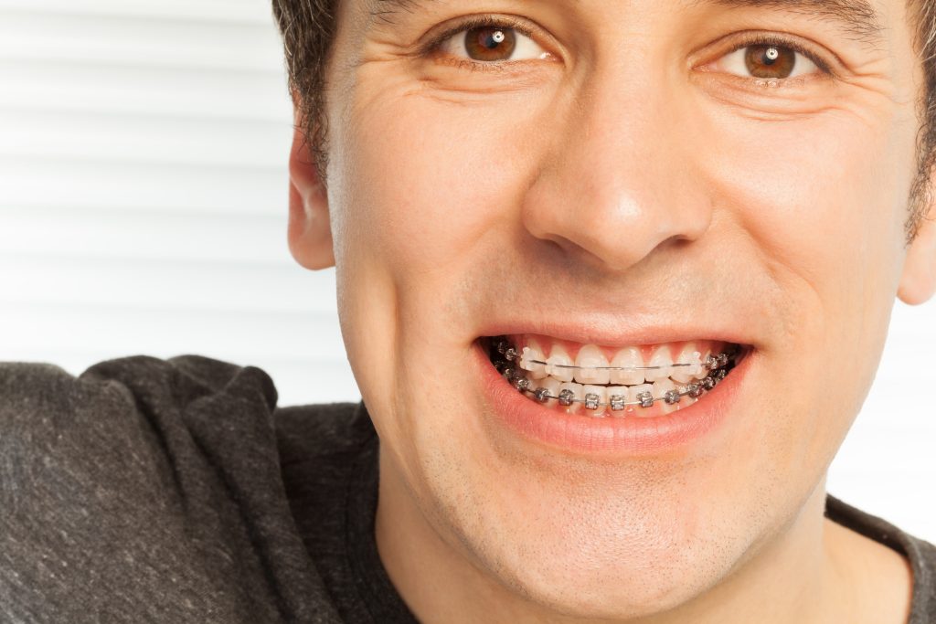 Tipos de brackets: cuál elegir y cuál es el mejor tratamiento para ti