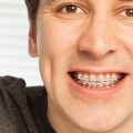 Tipos de brackets: cuál elegir y cuál es el mejor tratamiento para ti