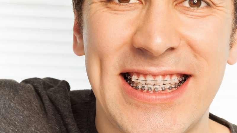 Tipos de brackets: cuál elegir y cuál es el mejor tratamiento para ti