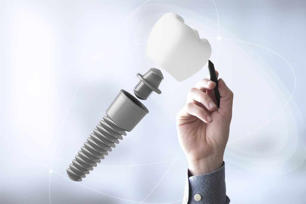 Rechazo del implante dental