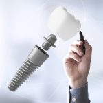 Rechazo del implante dental