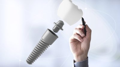 Rechazo del implante dental