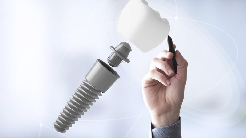 Rechazo del implante dental