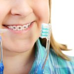 ¿Para qué sirven las ligas de brackets?