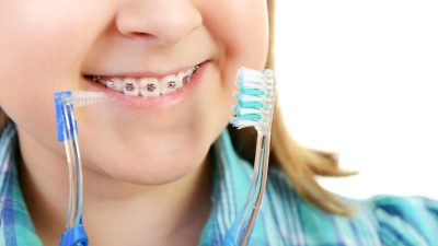 ¿Para qué sirven las ligas de brackets?