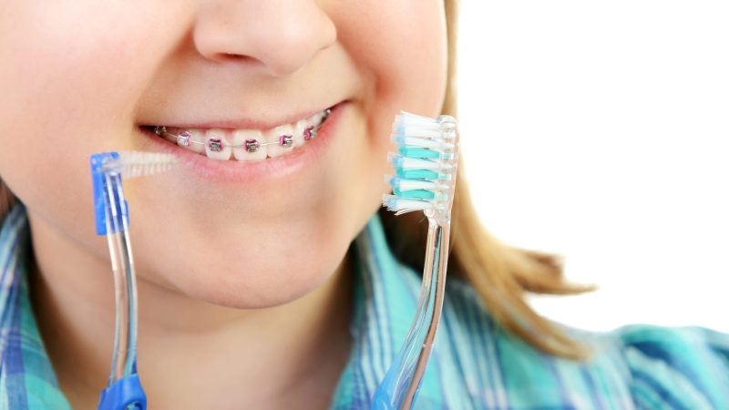 ¿Para qué sirven las ligas de brackets?