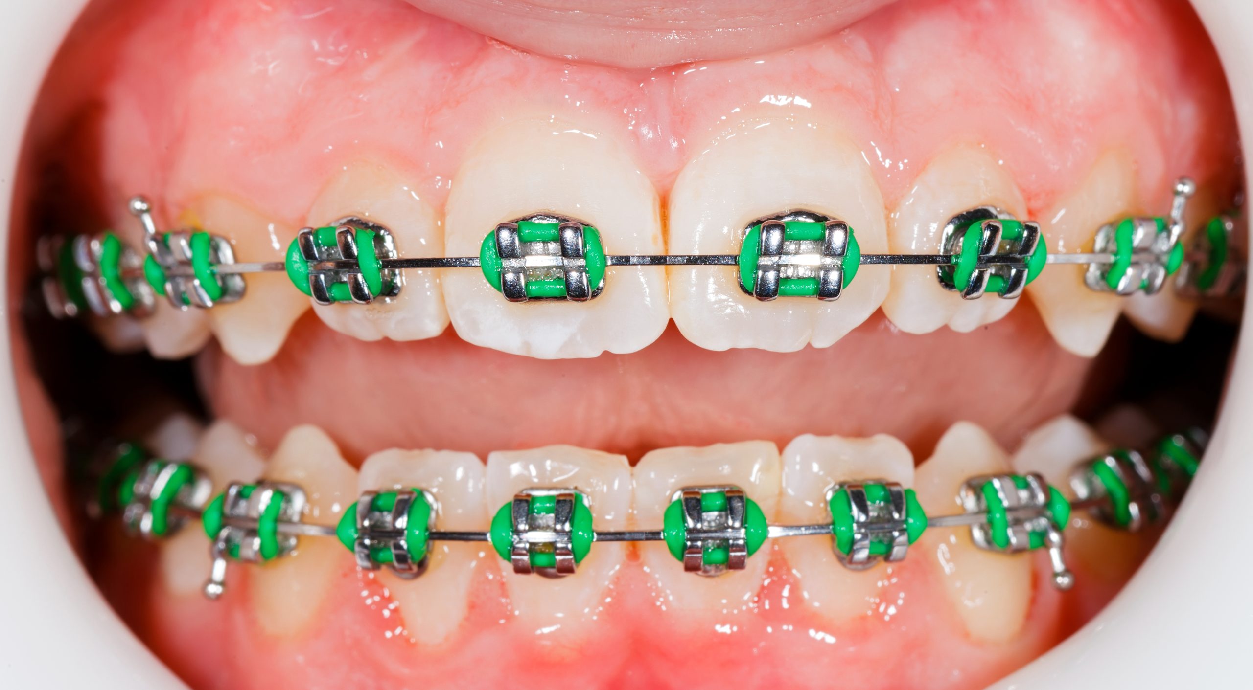 Dientes con brackets y ligas de ortodoncia
